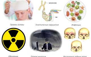 Особенности развития остеомы лобной кости и ее проявление у пациентов