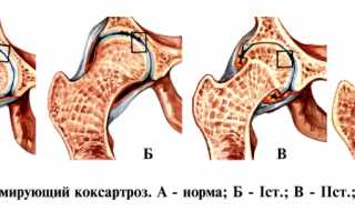 Лечение диспластического коксартроза тазобедренного сустава: методы и рекомендации