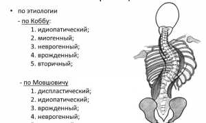 Характерные признаки грудопоясничного сколиоза у взрослых
