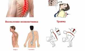 Признаки развития гемангиолипомы позвоночника и ее устранение: важные аспекты и рекомендации