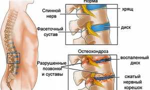 Причины и способы лечения защемления нерва в ноге: полезные советы