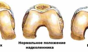 Появление боли в коленной чашечке при надавливании: причины и лечение