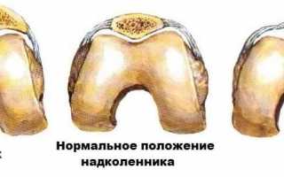 Появление боли в коленной чашечке при надавливании: причины и лечение