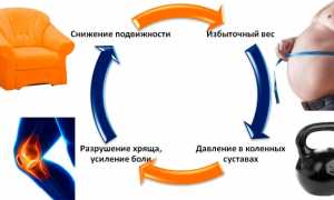 Стадии и лечение остеоартроза коленного сустава: важные аспекты и рекомендации
