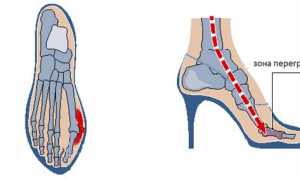 Hallux valgus: степени и лечение большого пальца ноги для здоровья