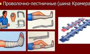 Что такое шина Дитерихса и как ее накладывать? Полное руководство