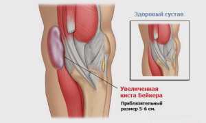 Проявление кисты Бейкера под коленом и ее лечение: причины и рекомендации