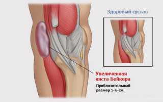 Проявление кисты Бейкера под коленом и ее лечение: причины и рекомендации