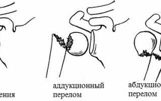 Как разработать руку после перелома плечевой кости? Полезные советы и рекомендации