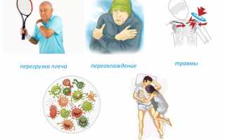 Причины возникновения миозита плеча и его лечение: важные аспекты