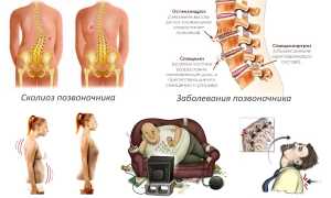 Фораминальная протрузия межпозвонкового диска: причины и лечение