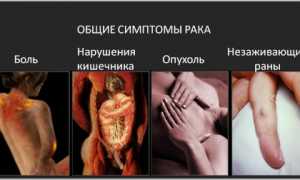 Симптомы развития саркомы Юинга и методы ее лечения: важная информация для пациентов