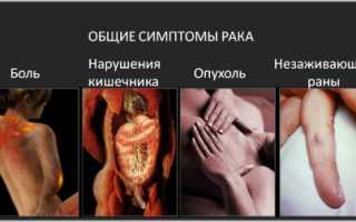 Симптомы развития саркомы Юинга и методы ее лечения: важная информация для пациентов