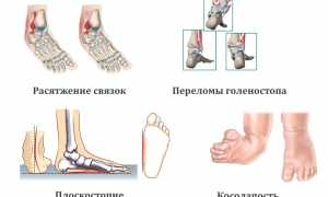 Как снять боли в области голеностопного сустава? Полезные советы и рекомендации.