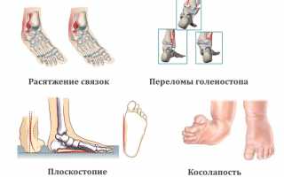 Как снять боли в области голеностопного сустава? Полезные советы и рекомендации.