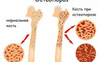 Эффективные лекарства от остеопороза для улучшения здоровья