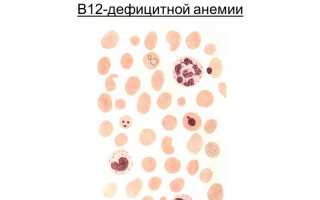 Особенности проявления фуникулярного миелоза и его лечение: важные аспекты и рекомендации