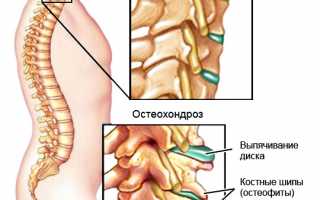 Как помогает корсет при шейном остеохондрозе? Полезные советы и рекомендации