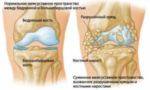 Проявление посттравматического артроза и его лечение: важные аспекты и рекомендации