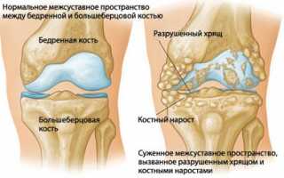 Проявление посттравматического артроза и его лечение: важные аспекты и рекомендации