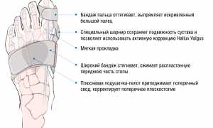 Вальгусная ортопедическая шина Hallufix: обзор изделия и его преимущества
