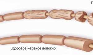 Почему возникает парестезия и как от нее избавиться? Полезные советы