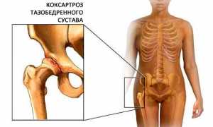 Выполнение массажа тазобедренного сустава при коксартрозе для улучшения состояния