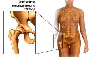 Выполнение массажа тазобедренного сустава при коксартрозе для улучшения состояния