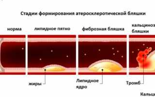 Чем опасен атеросклероз для здоровья человека