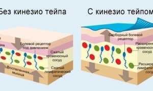 Как тейпировать мышцы тазобедренного сустава для улучшения восстановления?