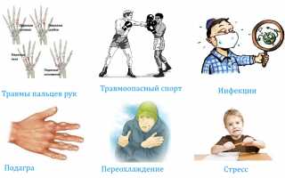 Каковы причины артроза пальцев рук и как его лечить? Полное руководство