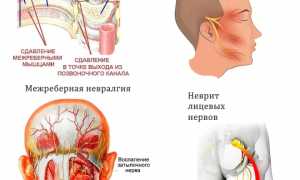 Причины появления невралгии и методы ее лечения: важные аспекты и рекомендации