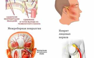 Причины появления невралгии и методы ее лечения: важные аспекты и рекомендации