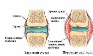 Признаки синовита коленного сустава и методы его лечения: важная информация для пациентов