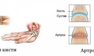 Обследование кисти руки с помощью рентгена для диагностики заболеваний