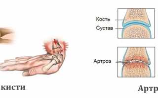 Обследование кисти руки с помощью рентгена для диагностики заболеваний