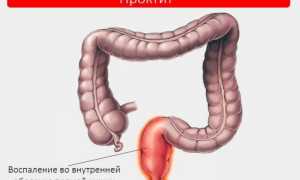 Проктит: симптомы, лечение и профилактика заболевания кишечника