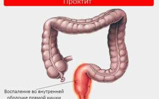 Проктит: симптомы, лечение и профилактика заболевания кишечника