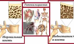 Применение Альфадола при недостатке кальция в организме для улучшения здоровья