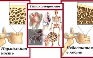 Применение Альфадола при недостатке кальция в организме для улучшения здоровья