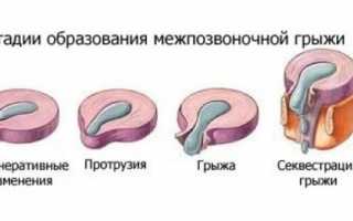 Обзор поясов от межпозвоночной грыжи и правила их применения для здоровья