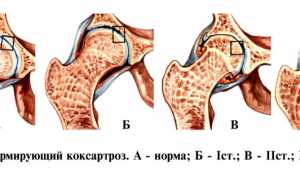 Кому положена инвалидность при артрозе суставов? Полный обзор