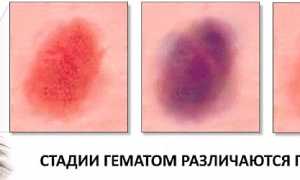 Разбираемся, можно или нельзя прогревать ушибы, и что важно знать