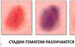 Разбираемся, можно или нельзя прогревать ушибы, и что важно знать