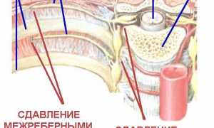 Протрузия межпозвонковых дисков грудного отдела: причины и лечение
