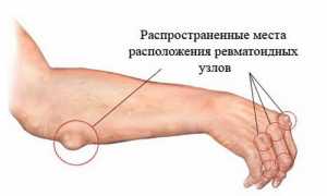 Признаки ревматизма суставов и способы его лечения: важные аспекты здоровья