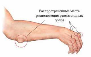 Признаки ревматизма суставов и способы его лечения: важные аспекты здоровья