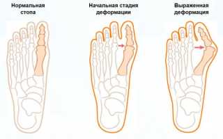 Выполнение гимнастики от косточек и шишек на ногах для здоровья