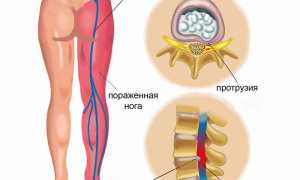 Основные симптомы ишиаса и способы лечения для улучшения качества жизни