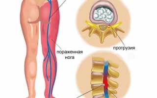 Основные симптомы ишиаса и способы лечения для улучшения качества жизни